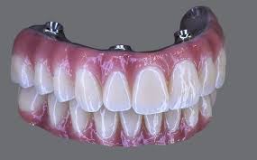 Transforming Smiles with All-On-4 Implants in Melbourne and Brisbane: A Modern Solution for Tooth Loss