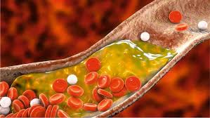 Triglycerides Treatment
